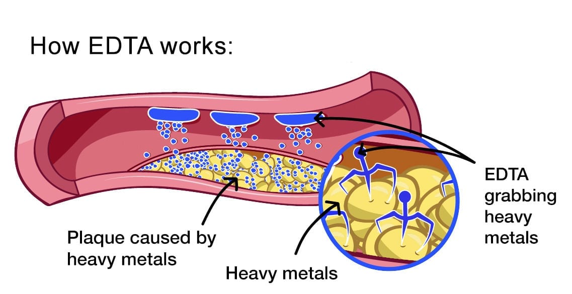 EDTA - Chelation Therapy - IV For Chronic Illness in Springfield Missouri