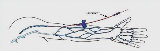 Laser Illustration Photodynamic Therapy Springfield Missouri