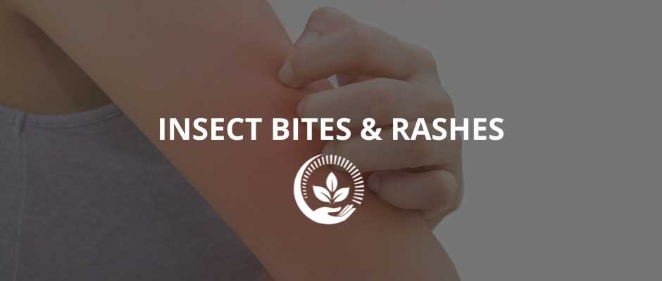 Insect-Bites-and-Rashes-Urgent Care-in-Springfield-Missouri